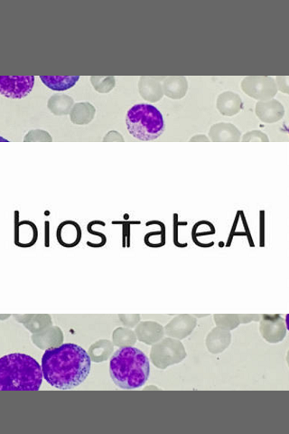 AI e RNA-seq per la cura personalizzata della leucemia